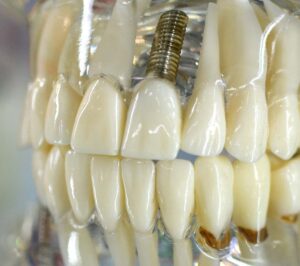 Affordable Dental Implants Kirkland