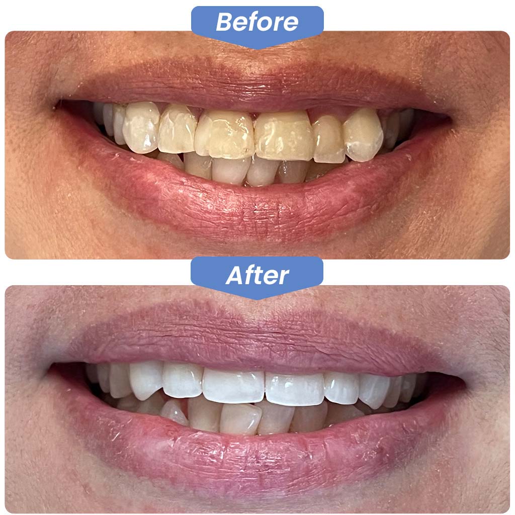 Before After New Teeth Crown