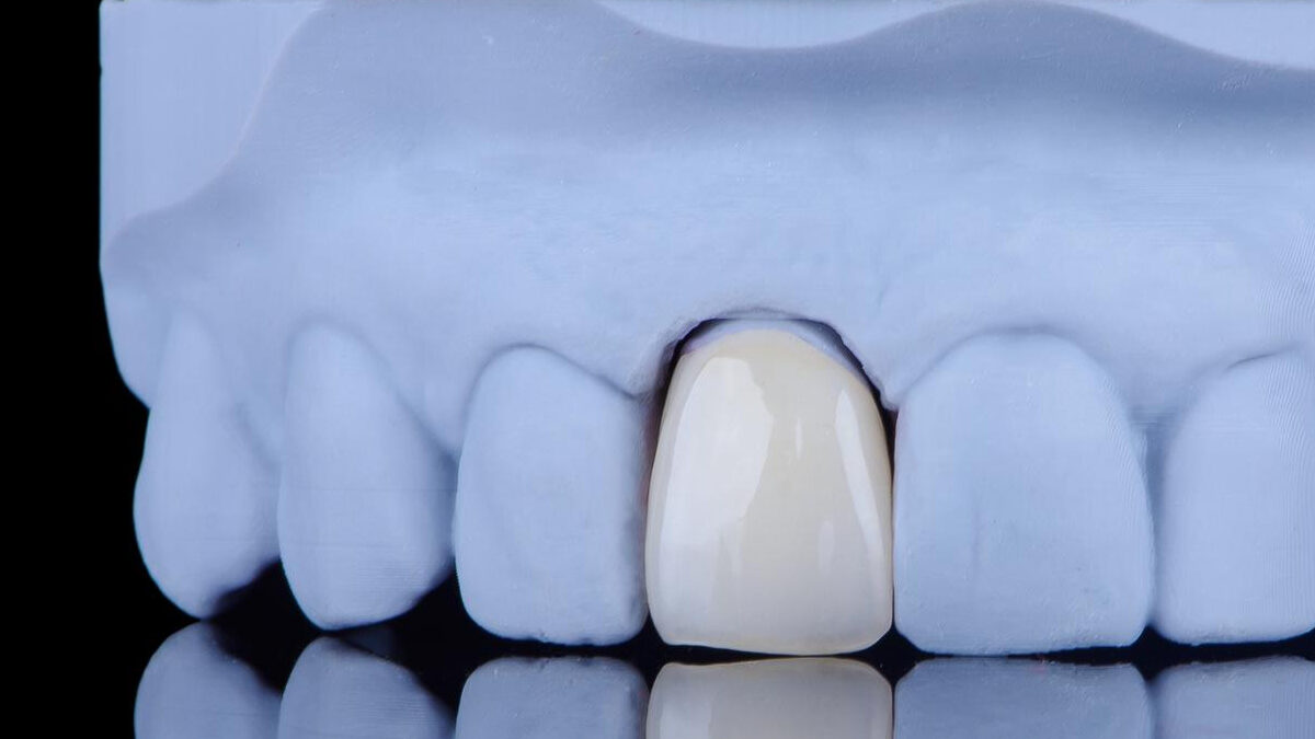 Can Dental Bridges Be Removable