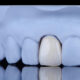 Can Dental Bridges Be Removable