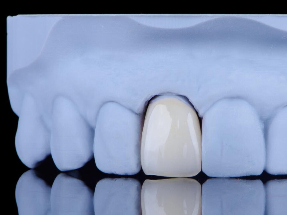 Can Dental Bridges Be Removable