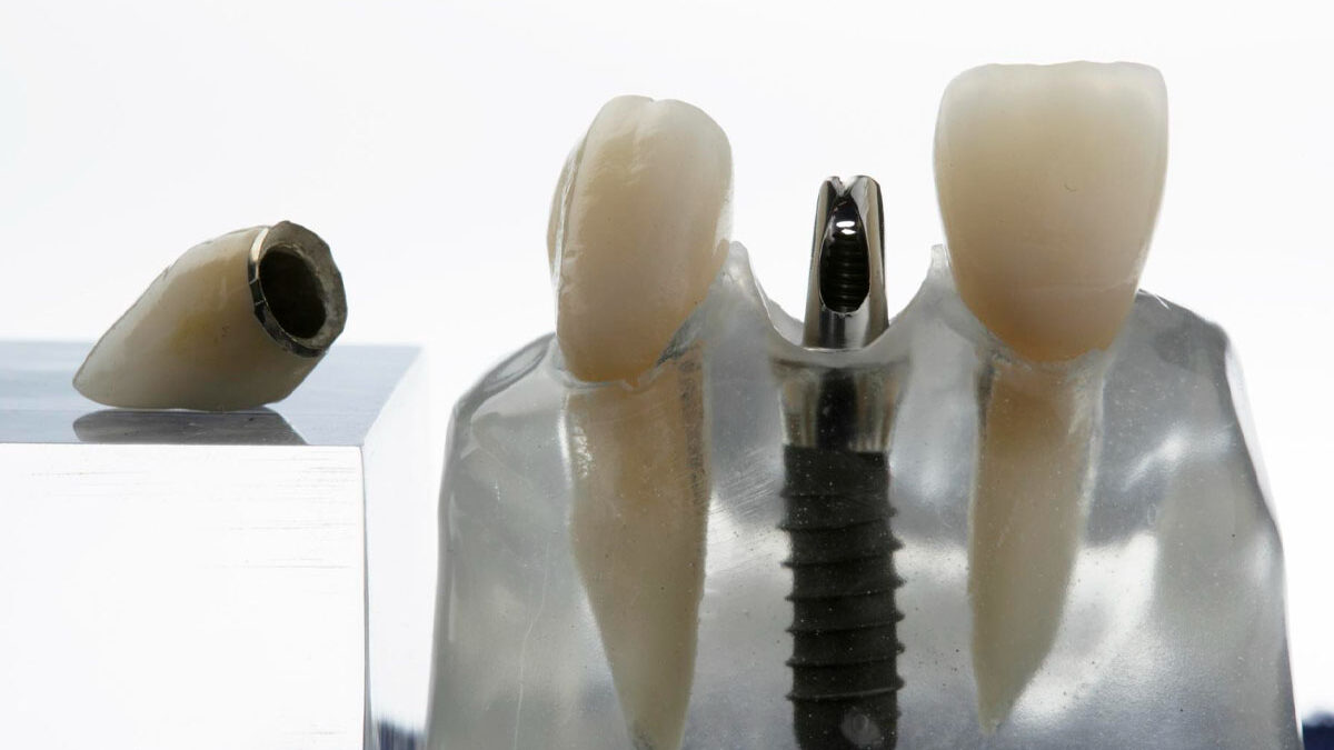 Can Dental Implants Be Removed?