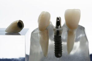 Can Dental Implants Be Removed?