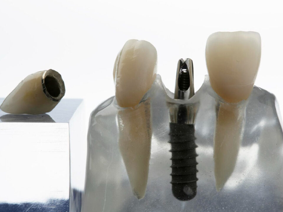 Can Dental Implants Be Removed?