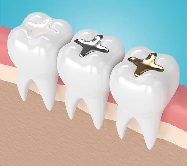 Composite Fillings