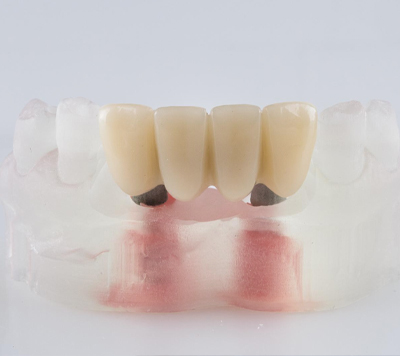 Dental Bridge