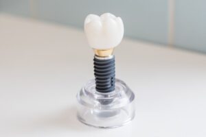 Dental Implant vs Crown What’s the Difference?