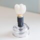 Dental Implant vs Crown What’s the Difference?