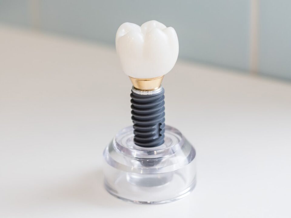 Dental Implant vs Crown What’s the Difference?