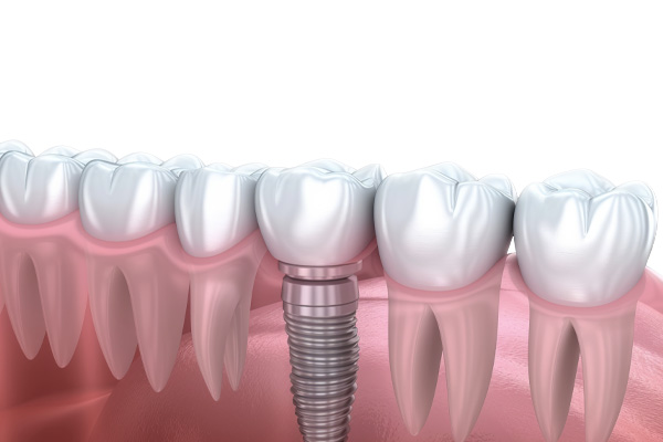 Dental Implants Back