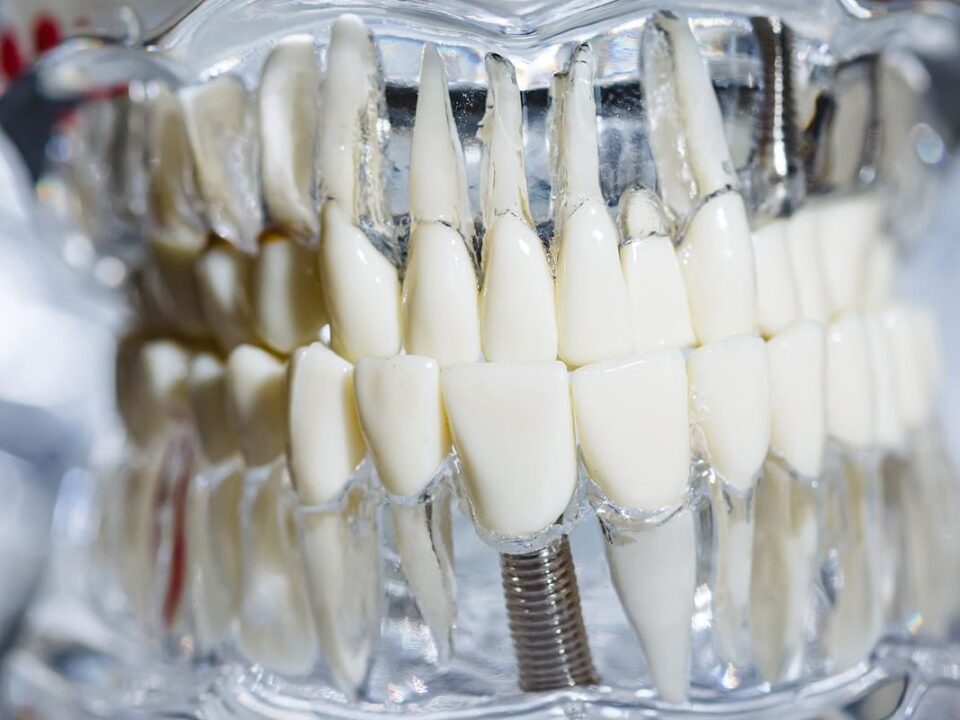 Do Dental Implants Change Your Smile?