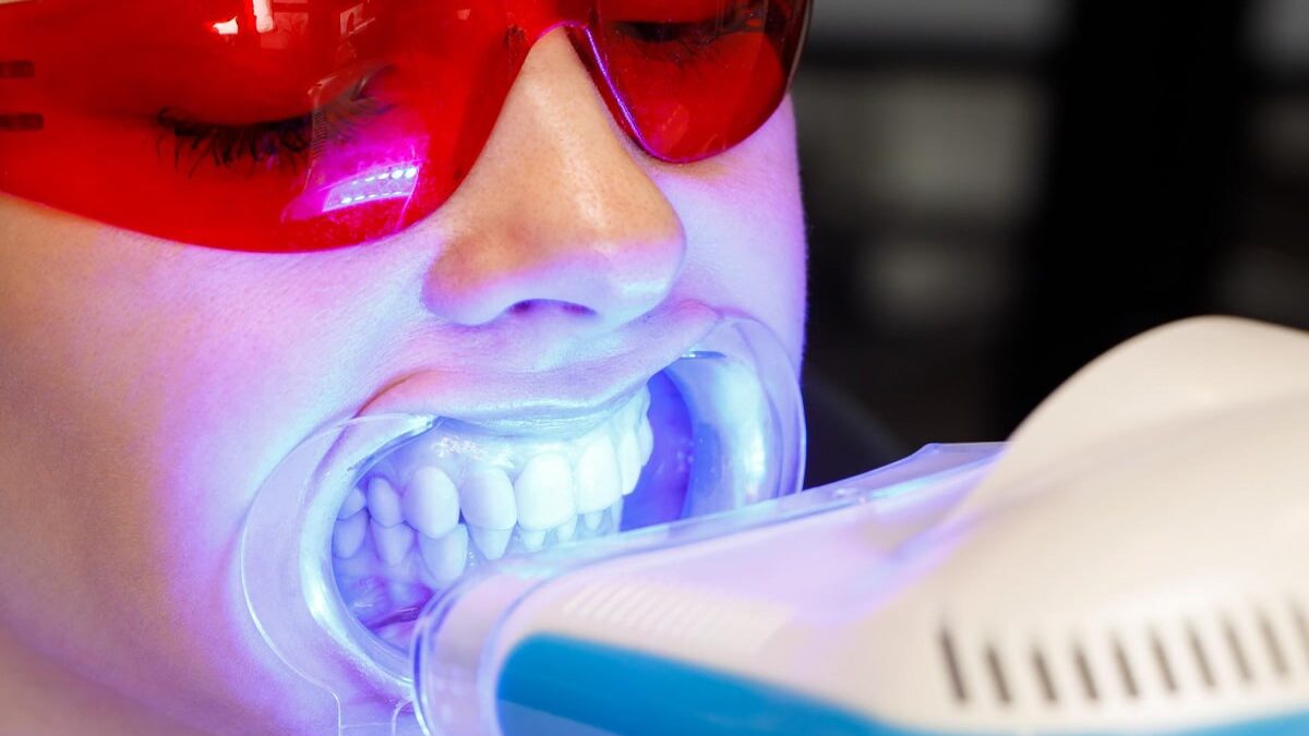 Do Teeth Whitening Trays Work?