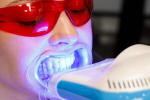 Do Teeth Whitening Trays Work?