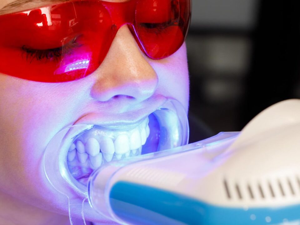 Do Teeth Whitening Trays Work?