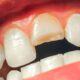 Fractured Tooth Symptoms: What You Need to Know