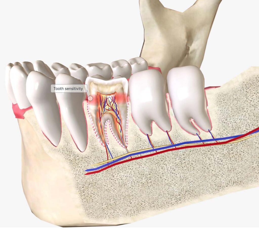 How to Avoid Root Canals