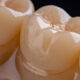 Metal Crowns vs. Porcelain Dental Crowns