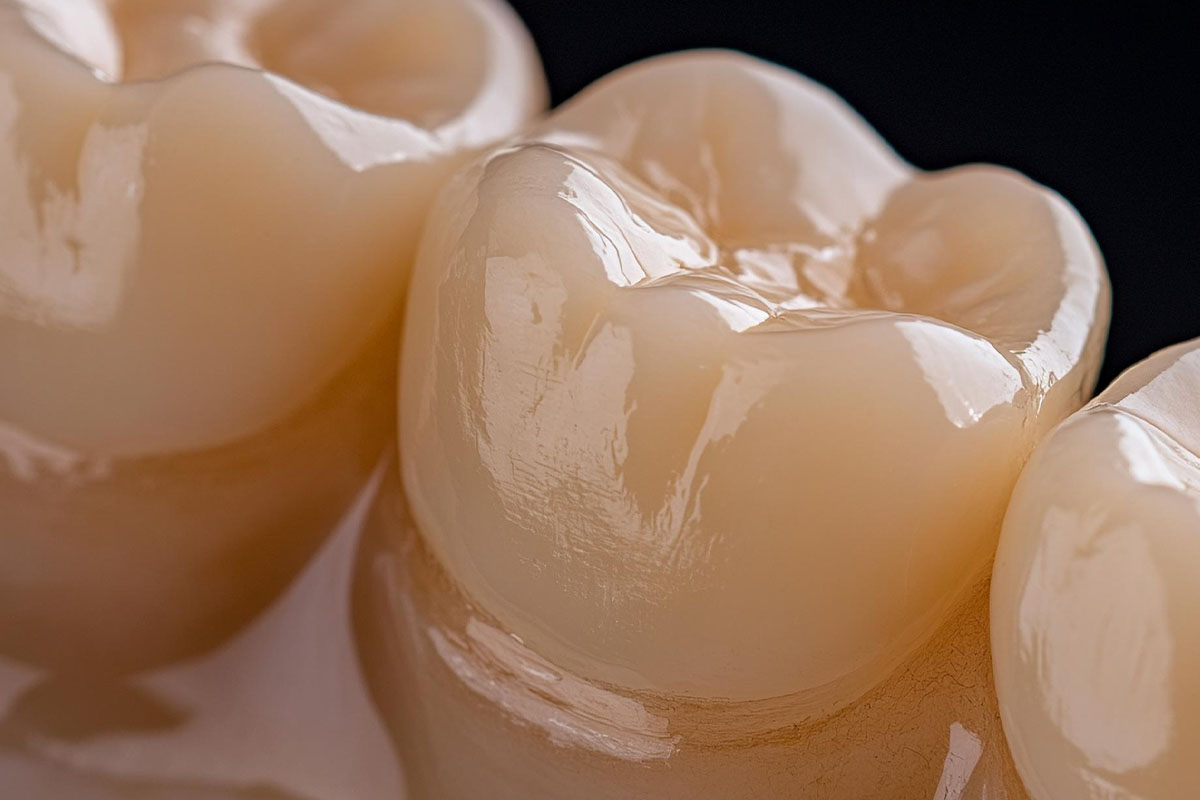 Metal Crowns vs. Porcelain Dental Crowns