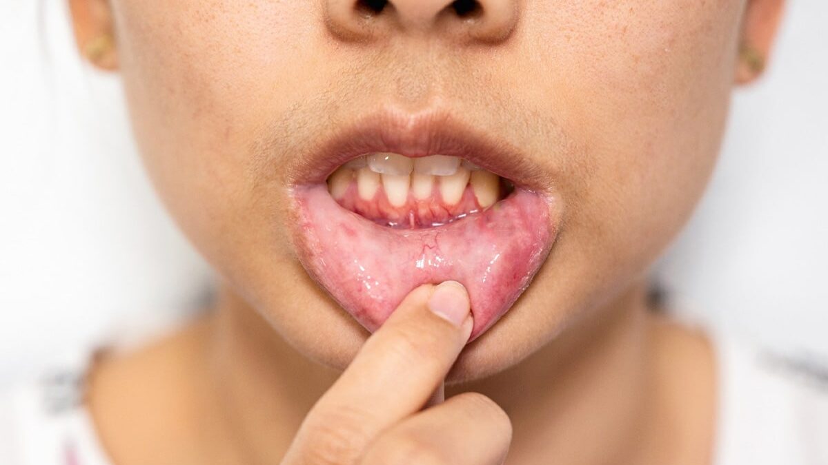 What Is the Difference Between a Mouth Ulcer and Mouth Cancer?