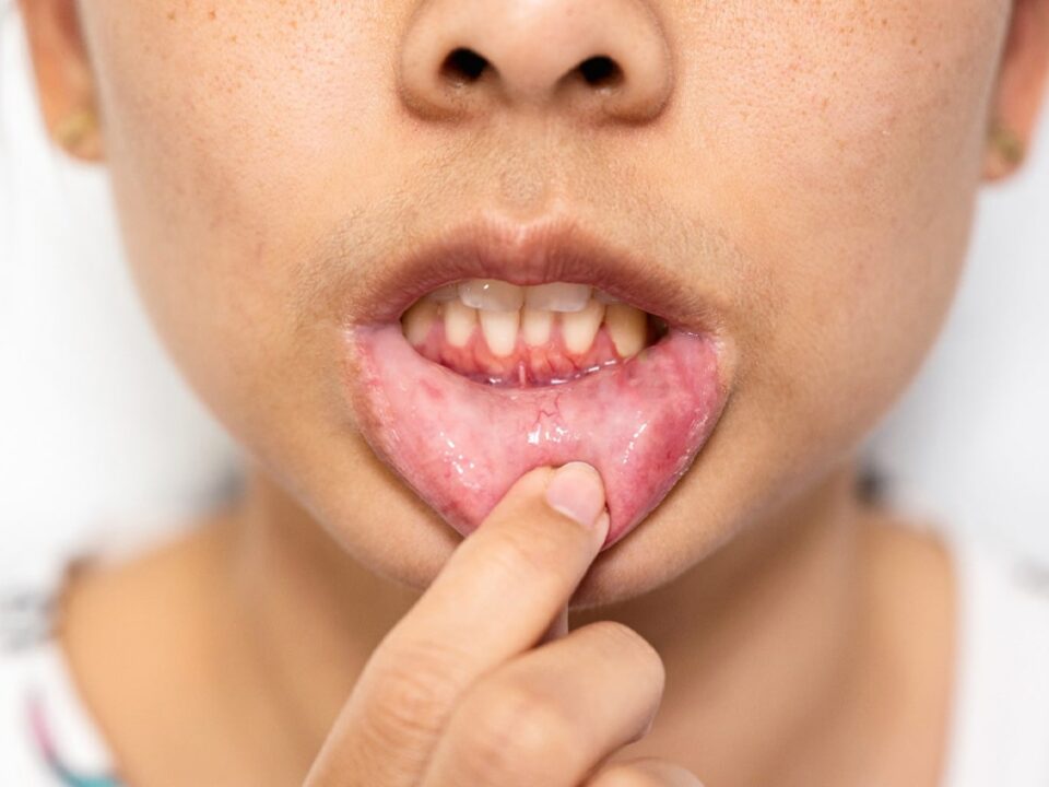 What Is the Difference Between a Mouth Ulcer and Mouth Cancer?