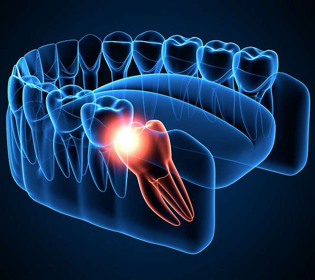 Wisdom Teeth Extraction